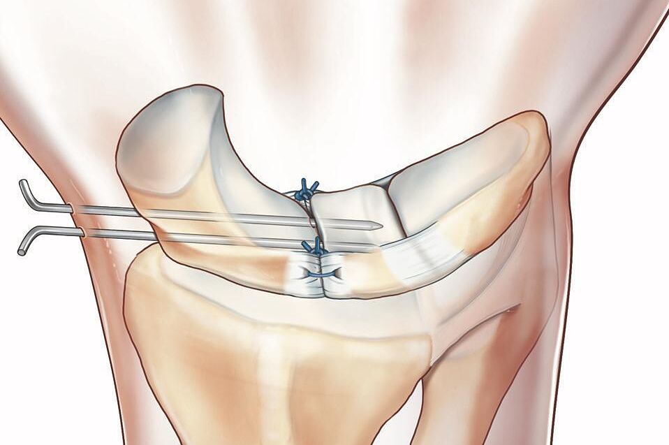 Imagen de cuál ha sido la técnica empleada con las agujas en la muñeca de Simón.