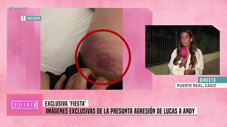 La imagen de la pierna de Andy tras la supuesta agresión de Lucas.