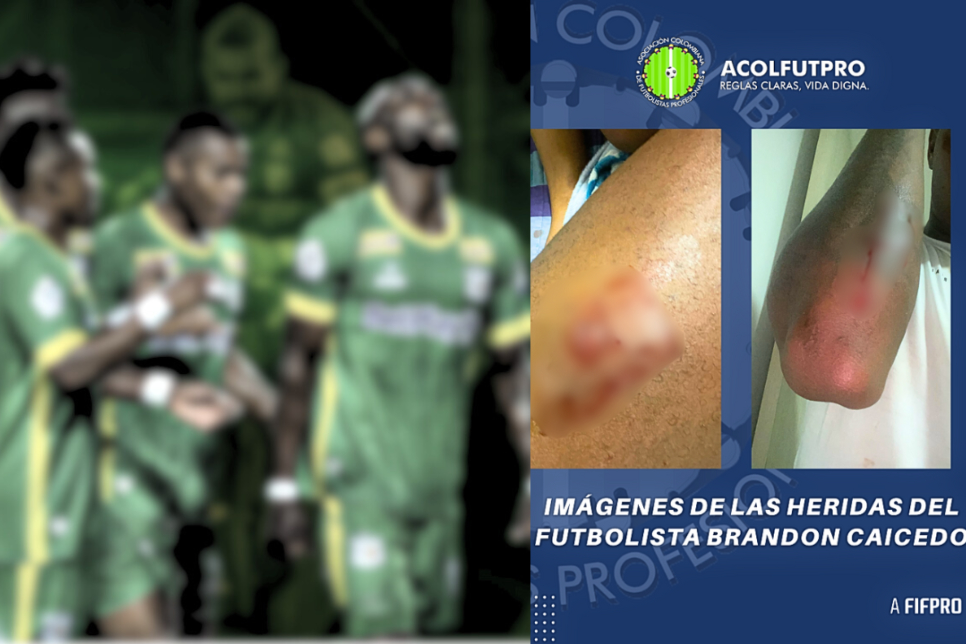 Supuestos 'barristas' del Deportes Quindío atacan con puñal al jugador Brandon Caicedo