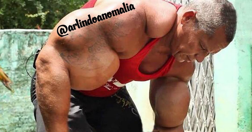 Muere Arlindo de Souza, el Popeye brasileño que se inyectaba aceite para tener los bíceps gigantes