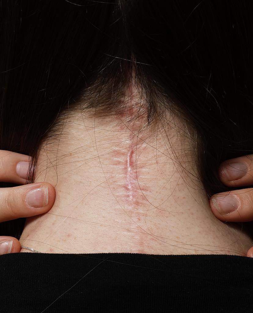 La cicatriz de la operación de Andrea Miguélez.