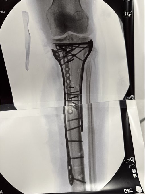 La radiografía de su pierna izquierda que ha compartido Vonn.