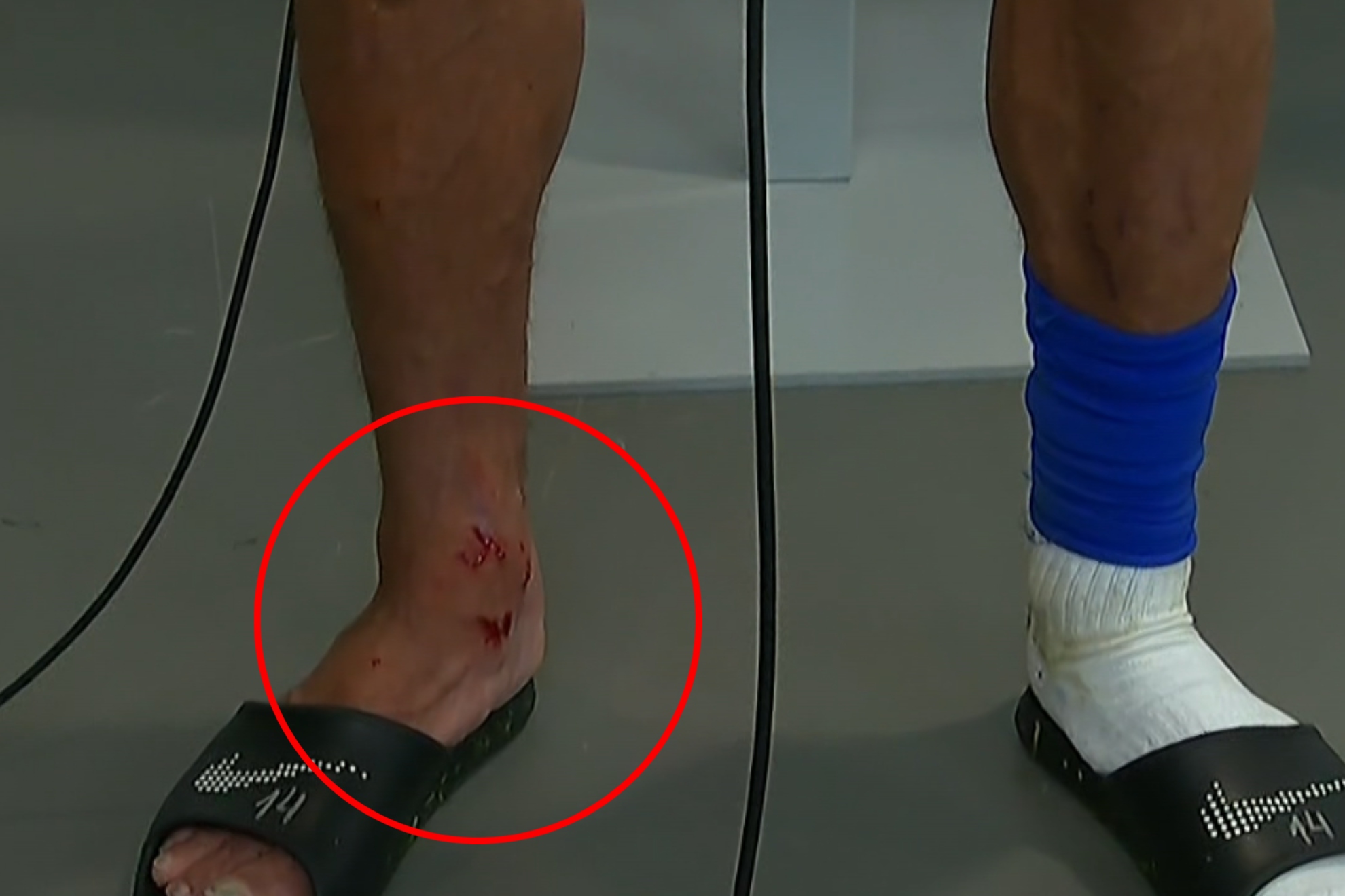 Una imagen del tobillo de Marcos Llorente.