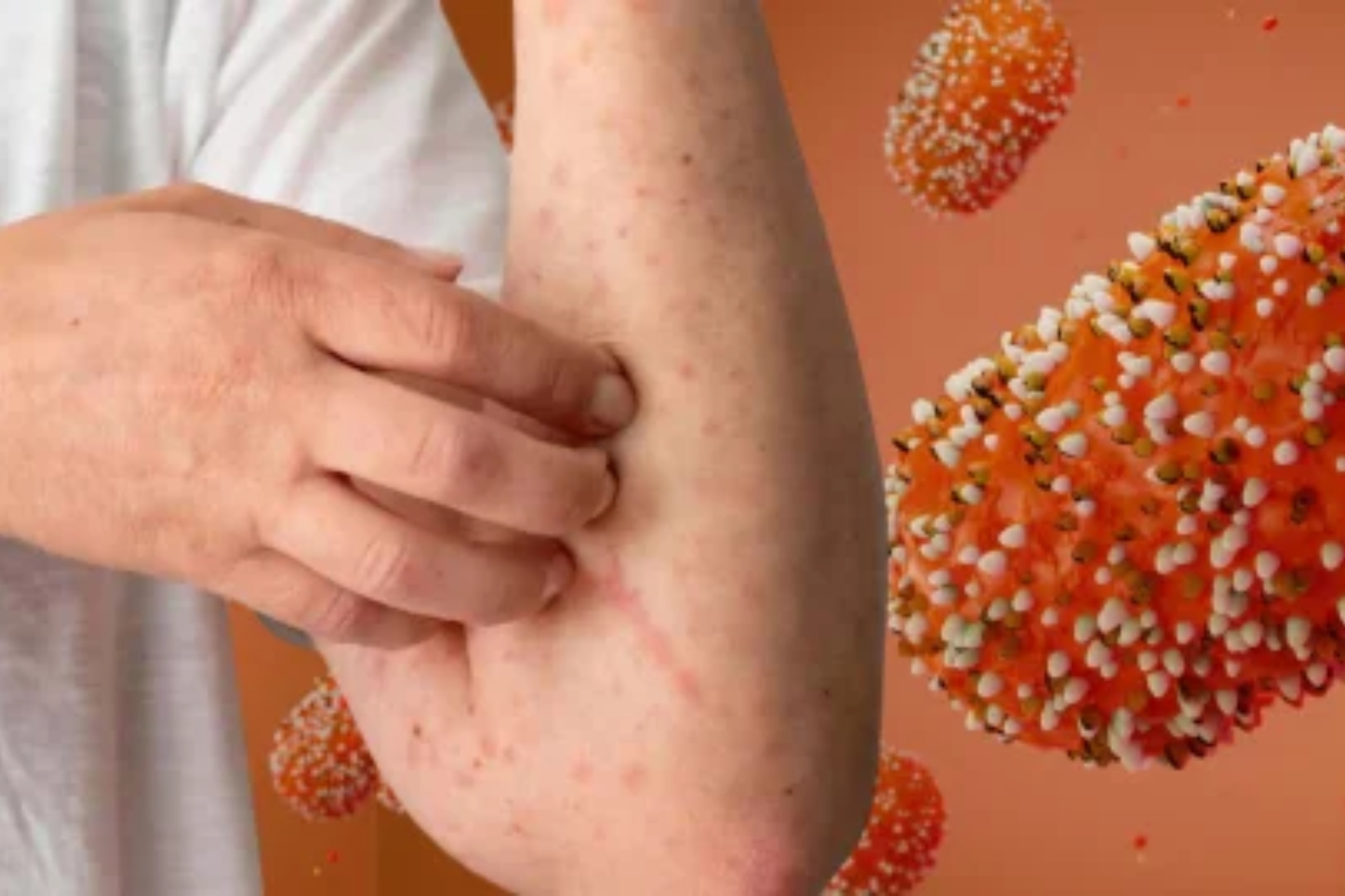 Mpox en Colombia: Minsalud confirma primer caso de la nueva variante clado Ib; síntomas y cómo se contagia.