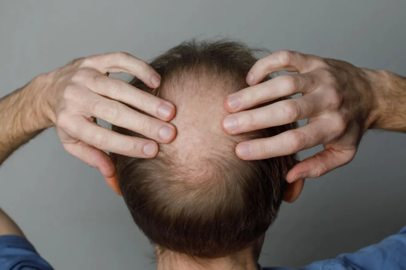 Hombre sin pelo.