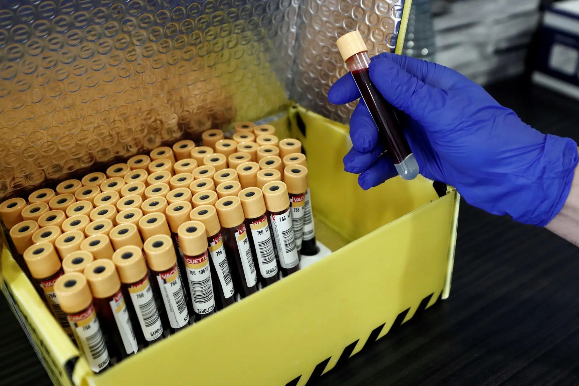 La Administración de Alimentos y Medicamentos de Estados Unidos autoriza análisis de sangre diseñados para detectar los primeros signos de Alzhéimer EFE