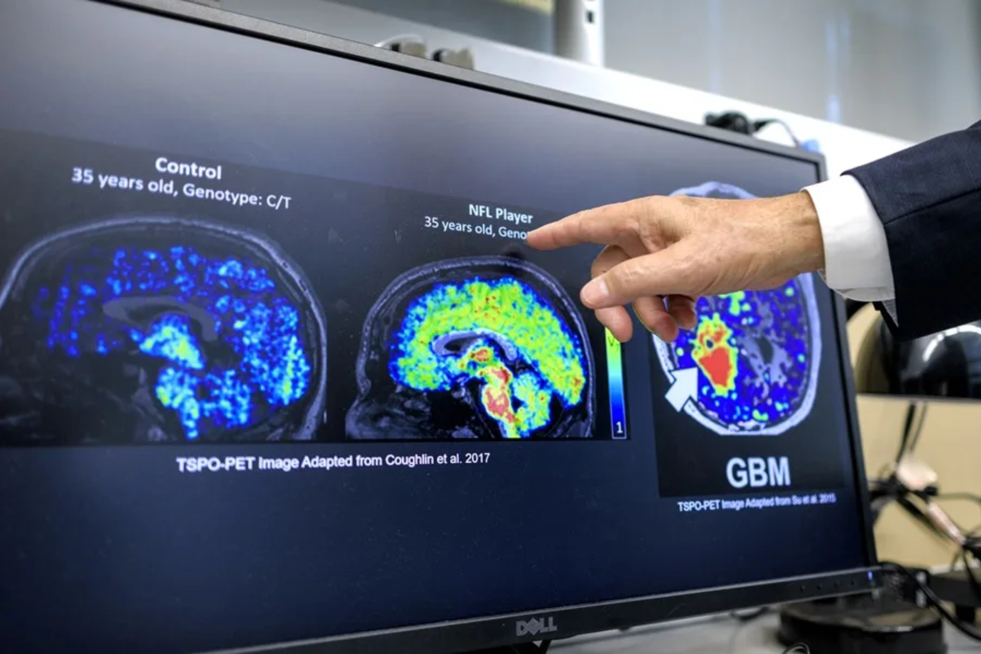 Radiografía de un cerebro EFE
