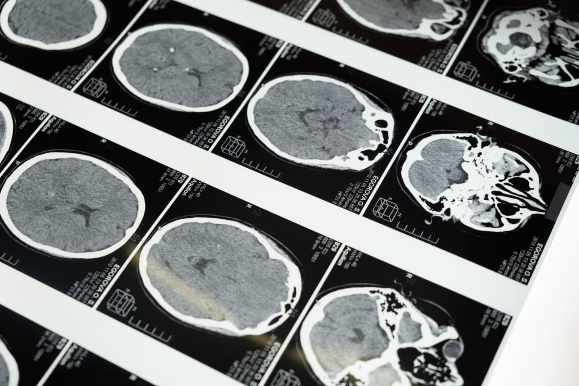 Un implante cerebral permite a personas con parálisis hablar y gesticular a través de un avatar. PEXELS