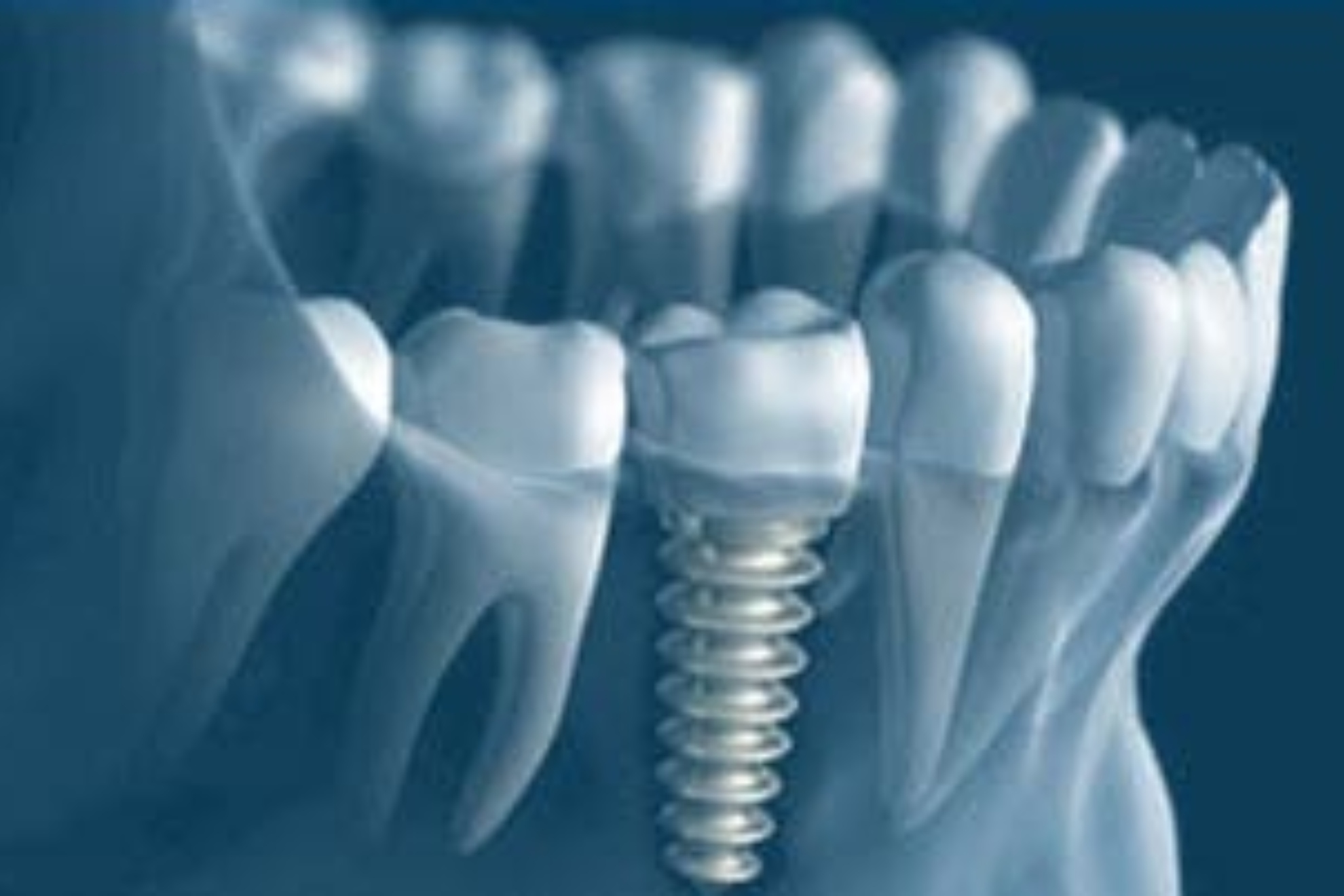 Los científicos advierten sobre los implantes dentales EFE